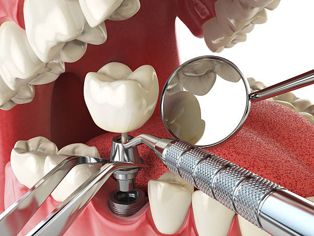 Best Emergency Dental Care for Abscessed Tooth in New Bern, NC